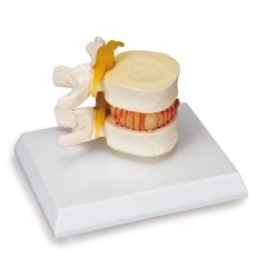 Simulator für Bandscheibenvorfall, 3B Scientific (1005326 [W22230])