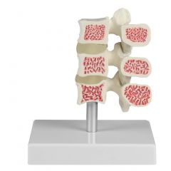 Osteoporose-Wirbel-Modell, 3 Wirbel, Erler & Zimmer (4078)