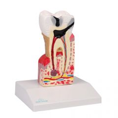 Zahnkariesmodell, 10-fache Größe, Erler & Zimmer (EZ D214)