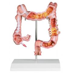 Dickdarmmodell mit Erkrankungen, verkleinerte Darstellung, auf Stativ, Erler & Zimmer (EZ K285)